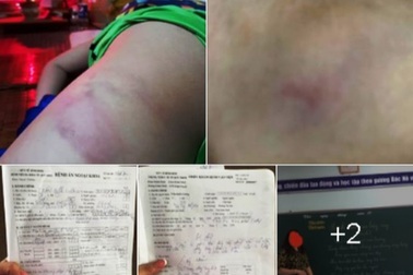 Làm rõ thông tin phụ huynh tố giáo viên chủ nhiệm đánh học sinh bầm tím