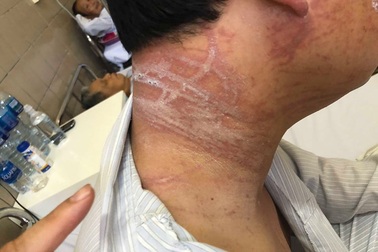 Sứa khổng lồ tấn công, du khách chằng chịt vết thương trên lưng như roi đánh