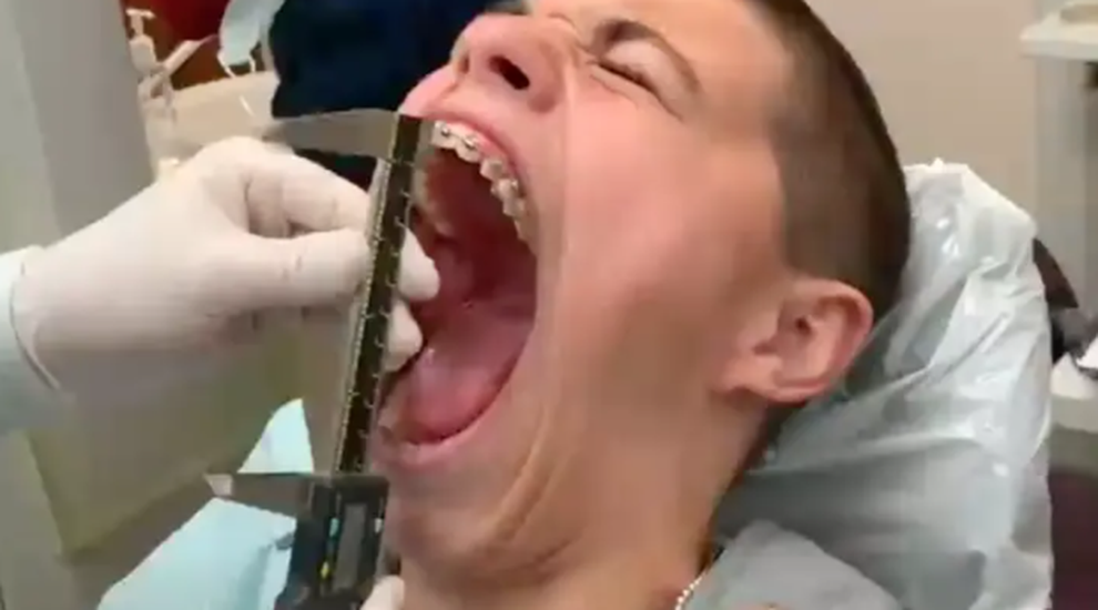 Thiếu niên có miệng rộng nhất hành tinh - 1