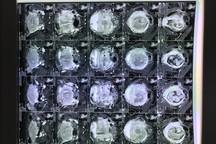 6 yếu tố làm tăng nguy cơ ung thư cổ tử cung