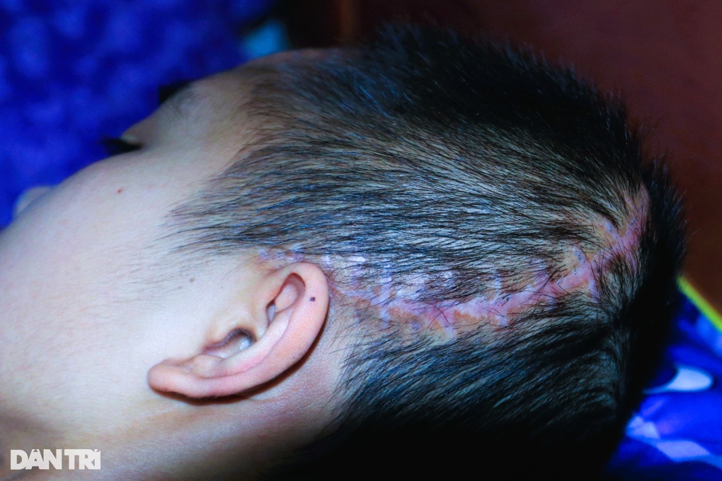 Sự sống mong manh của nữ sinh xinh đẹp sau vụ tai nạn kinh hoàng - 3 Sự sống mong manh của nữ sinh xinh đẹp sau vụ tai nạn kinh hoàng - 3