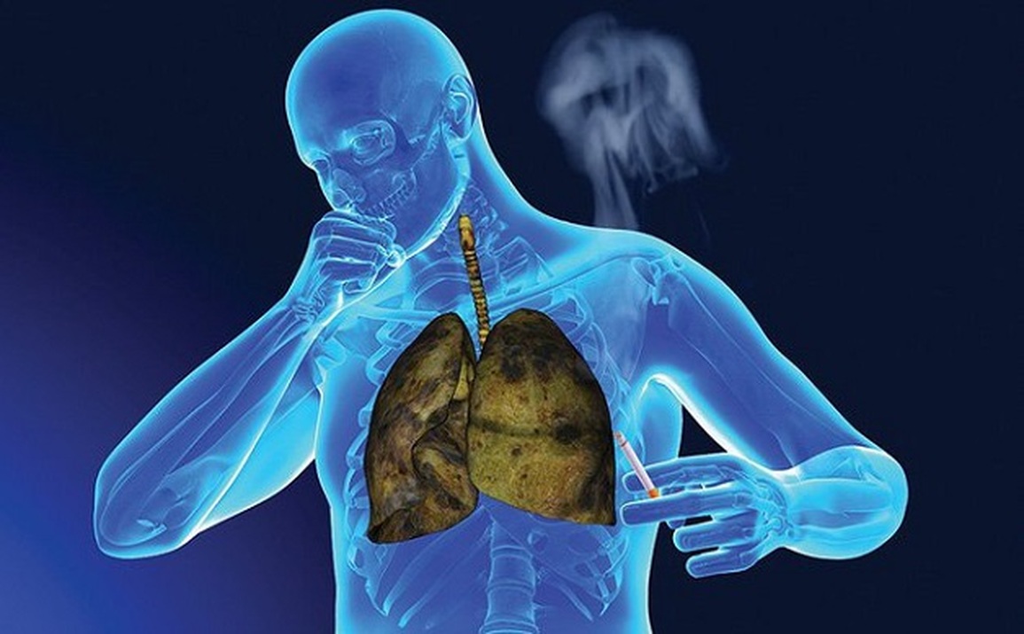 Ung thư phổi không tế bào nhỏ: Triệu chứng sớm và khi đã di căn - 1 Ung thư phổi không tế bào nhỏ: Triệu chứng sớm và khi đã di căn - 1