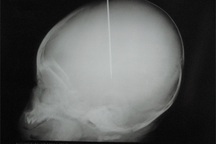 Hành động đâm kim vào đầu cháu bé thật quá man rợ