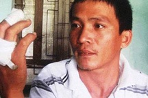 Hy hữu người đàn ông bị thương vì điếu thuốc phát nổ 