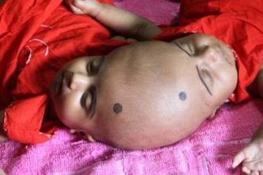 Cặp song sinh dính liền đỉnh đầu ở Bangladesh