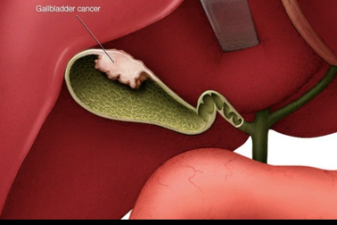 Có phát hiện được sớm ung thư túi mật không?