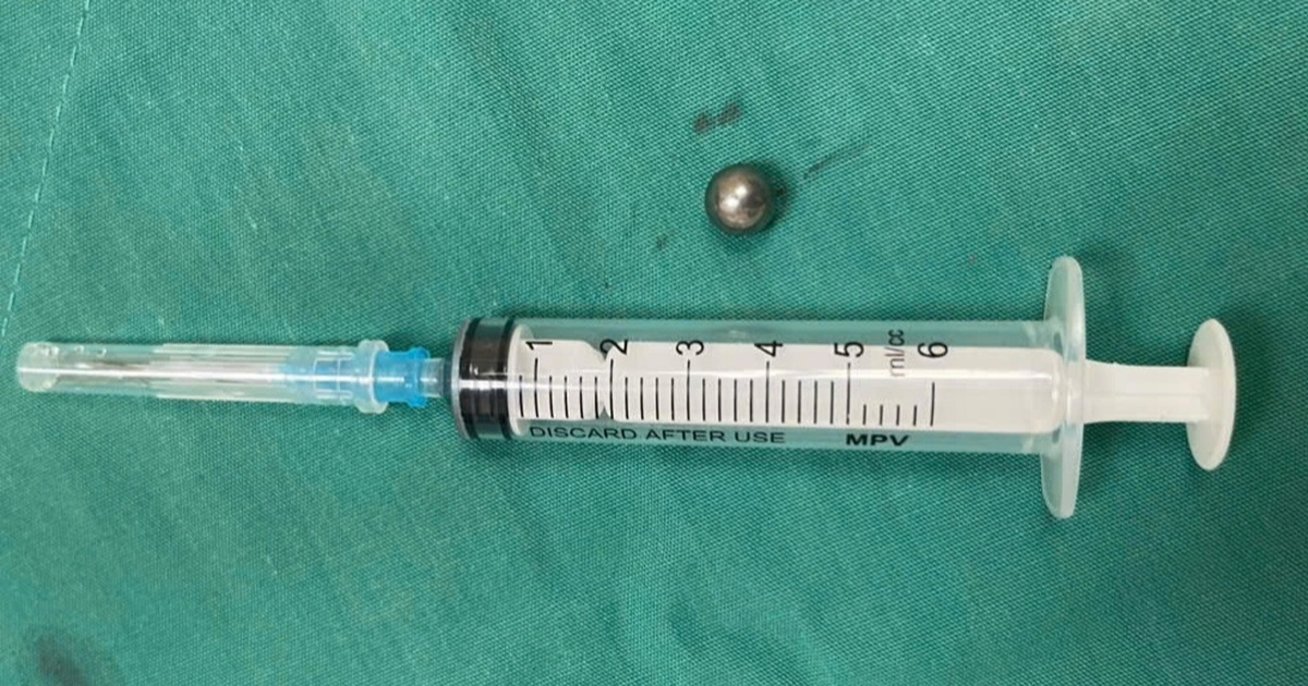 Bé trai 5 tuổi bị đạn từ súng đồ chơi bắn xuyên thủng mặt