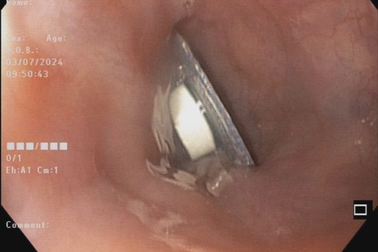 Tai nạn khi ăn uống khiến nhiều người lâm nguy, tử vong