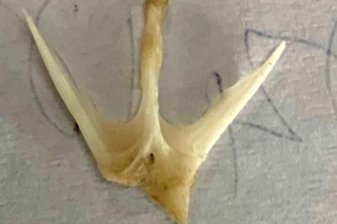 Xương cá 4 chấu nguy hiểm nằm trong thực quản bé 19 tháng tuổi