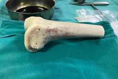 Ghép xương từ người cho chết não cứu nhiều người u xương tế bào khổng lồ "ăn" xương đùi