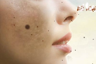 Những sai lầm khi điều trị nám