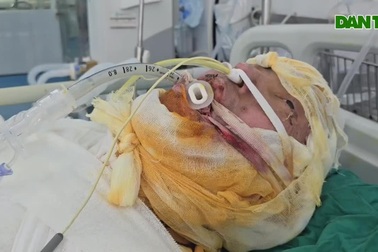 Bỏng điện cao thế, chàng trai dân tộc Mông nguy kịch tính mạng