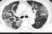 11 bệnh lý thường gặp làm tăng nguy cơ tử vong do Covid-19