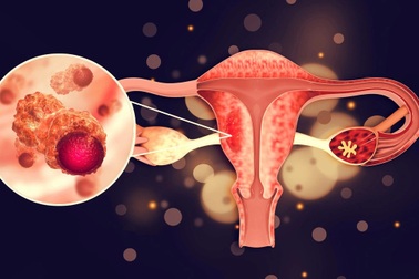 Chứng rối loạn phổ biến ở phụ nữ có thể dẫn đến ung thư buồng trứng