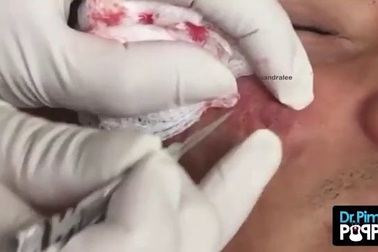 Quá trình lấy mụn bọc nằm sâu dưới da