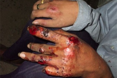 TPHCM: Phát hiện 8 trường hợp bị bệnh phong