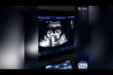 Chị em song sinh "đánh nhau" trong bụng mẹ