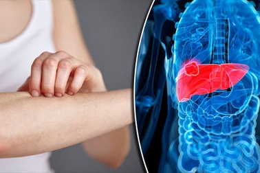 Sút cân, mệt mỏi có phải đã mắc ung thư gan?