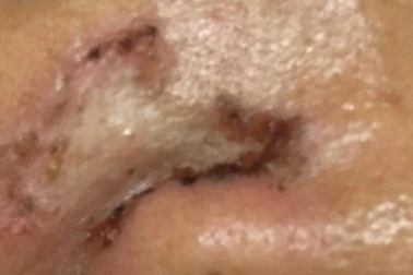 Dấu hiệu ung thư da dễ nhầm bệnh thông thường