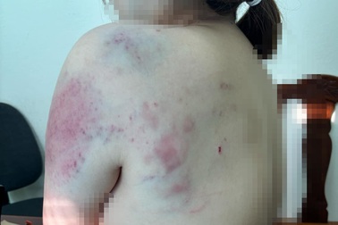 Người phụ nữ tố bị chồng hờ hành hung liên tục nhiều giờ