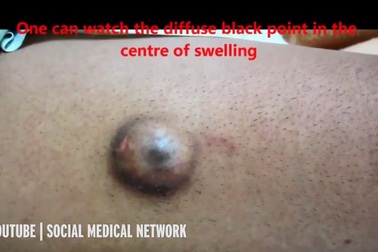 Hết hồn khối u “quái thú” giống như đôi mắt người