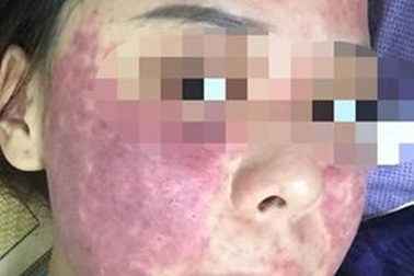 Mặt xuất huyết tím đen vì dùng kem trị mụn mua qua facebook