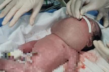 Bé gái sơ sinh mang khối u khổng lồ hiếm gặp