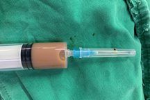 Nửa lít dịch mủ tụ trong người chỉ vì... chữa đau lưng