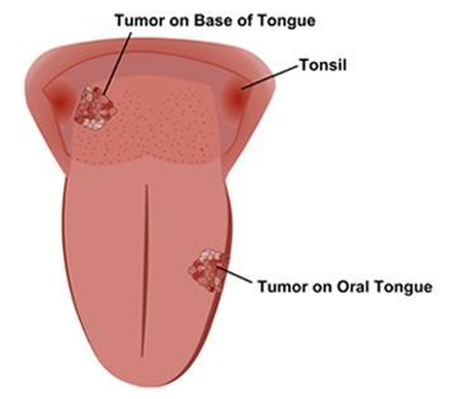 Dấu hiệu ung thư lưỡi giai đoạn cuối - 1 Dấu hiệu ung thư lưỡi giai đoạn cuối - 1