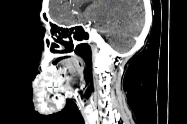 Bác sĩ choáng váng với khối u phủ kín miệng người bệnh