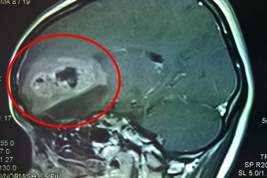 Đau đầu, mất ngủ kéo dài suốt 1 tháng vì  u não