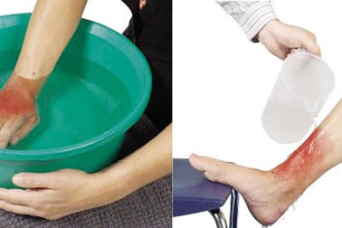 “Thời gian vàng” giúp nạn nhân bị bỏng hạn chế tai biến