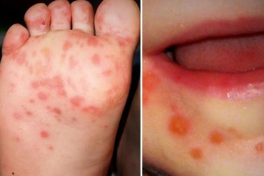 TPHCM: Cảnh báo virus EV71 gây bệnh tay chân miệng nặng đã tái xuất hiện