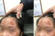 Thực hư thông tin nữ sinh lớp 6 bị bạn học "dùng dao rọc giấy rạch lên mặt"