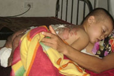 Bé 2 tuổi bỏng nặng vì ngã vào nồi nước sôi