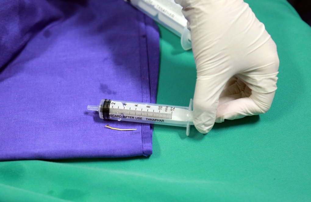 Người phụ nữ thủng ruột vì thói quen sau khi ăn của nhiều người Việt - 3 Người phụ nữ thủng ruột vì thói quen sau khi ăn của nhiều người Việt - 3