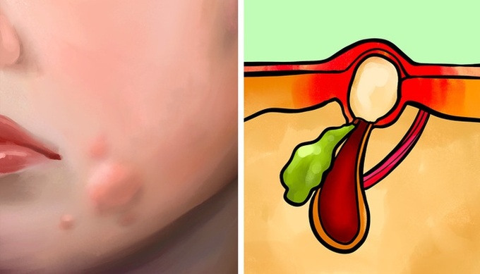 Phân biệt 6 loại mụn trứng cá từ nhẹ đến nặng: Nguyên nhân gây mụn và cách xử lý hiệu quả nhất - Ảnh 7.