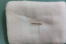 Cố chịu đau bụng, chàng trai trẻ vào viện thì đã dính ruột, thủng ruột non