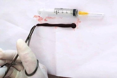 Uống nước khe, cháu bé 4 tuổi bị đỉa sống kí sinh trong mũi