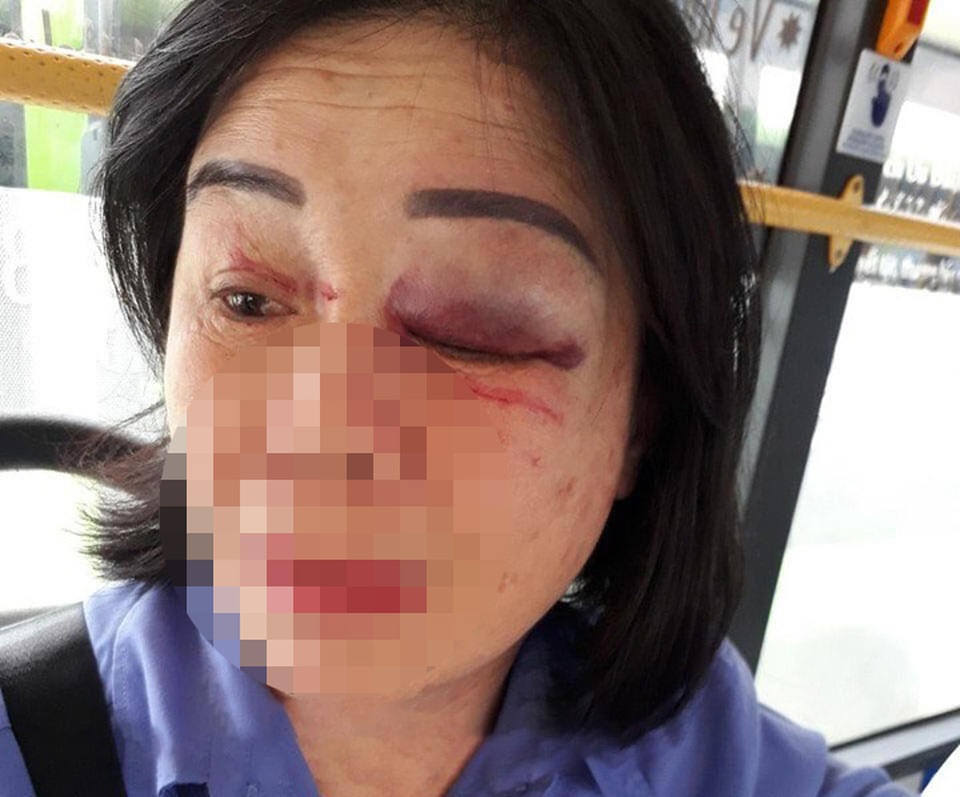 Nhắc mở nhạc nhỏ, nữ tiếp viên xe buýt bị hành khách đánh bầm mắt - 1 Nhắc mở nhạc nhỏ, nữ tiếp viên xe buýt bị hành khách đánh bầm mắt - 1