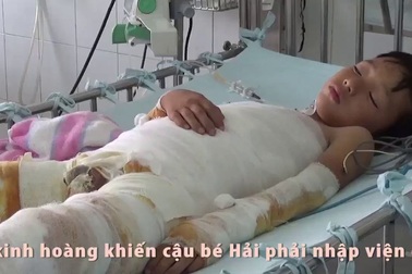 Bị bỏng cồn, tính mạng cậu bé 10 tuổi dân tộc Dao nguy kịch.
