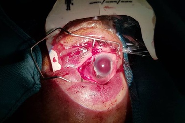 Quảng Bình: Hy hữu cụ bà bị gà mổ mắt gây tổn thương nghiêm trọng