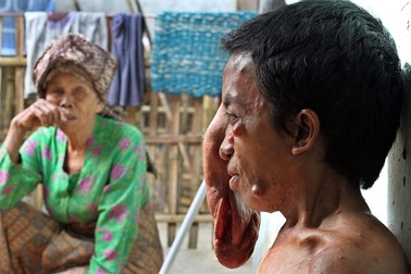 Indonesia: "Người mặt voi" khiến ai nhìn cũng khiếp sợ