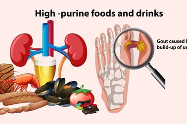 3 thói quen xấu khiến axit uric tăng cao