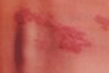 Tại sao tôi bị zona?