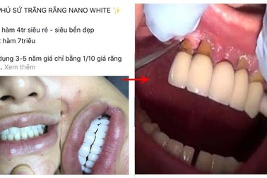 Những hiểu lầm về bọc răng sứ