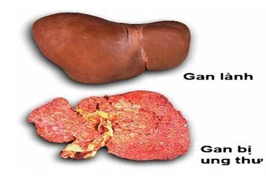 Điều trị ung thư gan theo cách này có thể kéo dài cuộc sống?