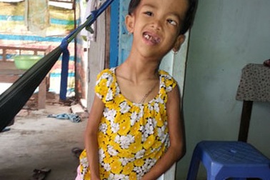 Thương em bé 6 tuổi mắc bệnh lạ "bên trái to ra, bên phải teo lại"