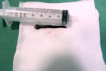 Con vắt “khủng” dài 8cm sống 2 tuần trong họng người đàn ông