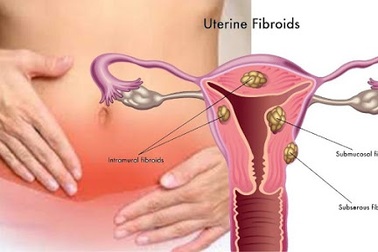 Sarcom thân tử cung là bệnh lý ác tính hiếm gặp